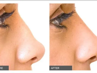 تجميل الأنف بالفيلر